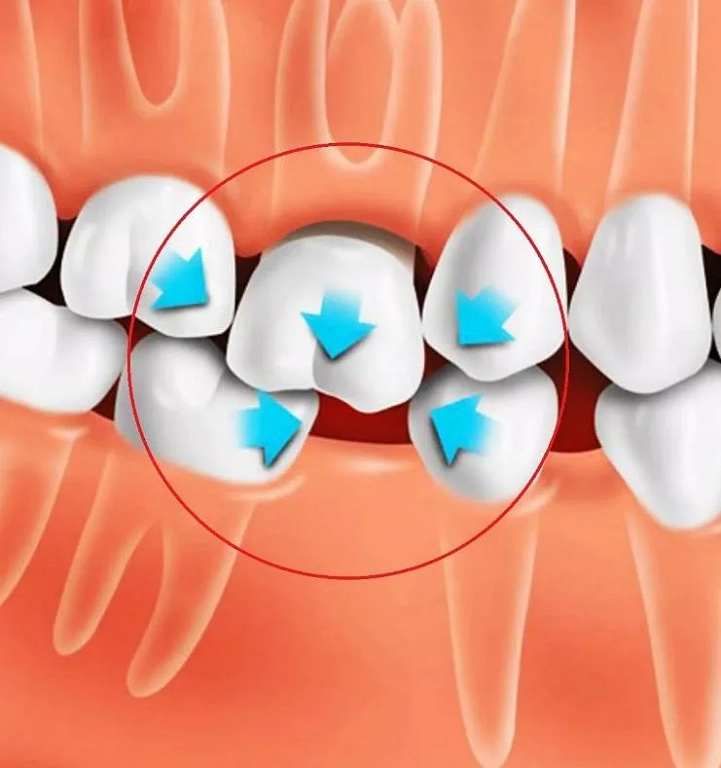 Удаление зуба без анестезии