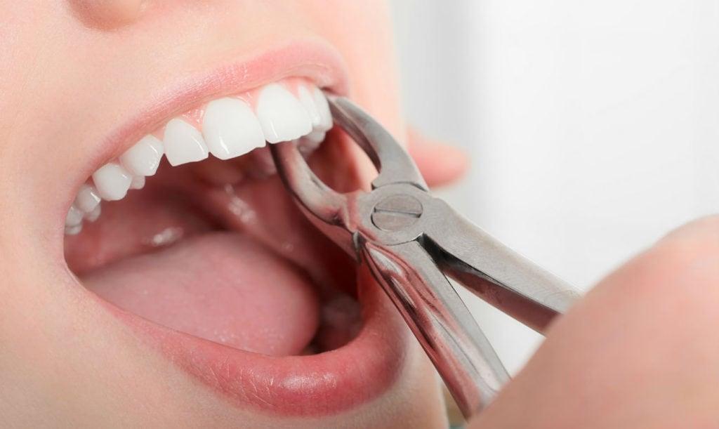 Остался осколок после удаления зуба: почему это происходит?